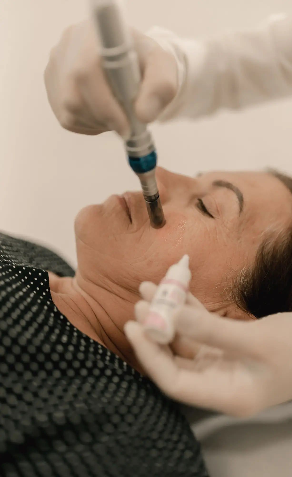 Microneedling në fytyrë me pen dermatologjik